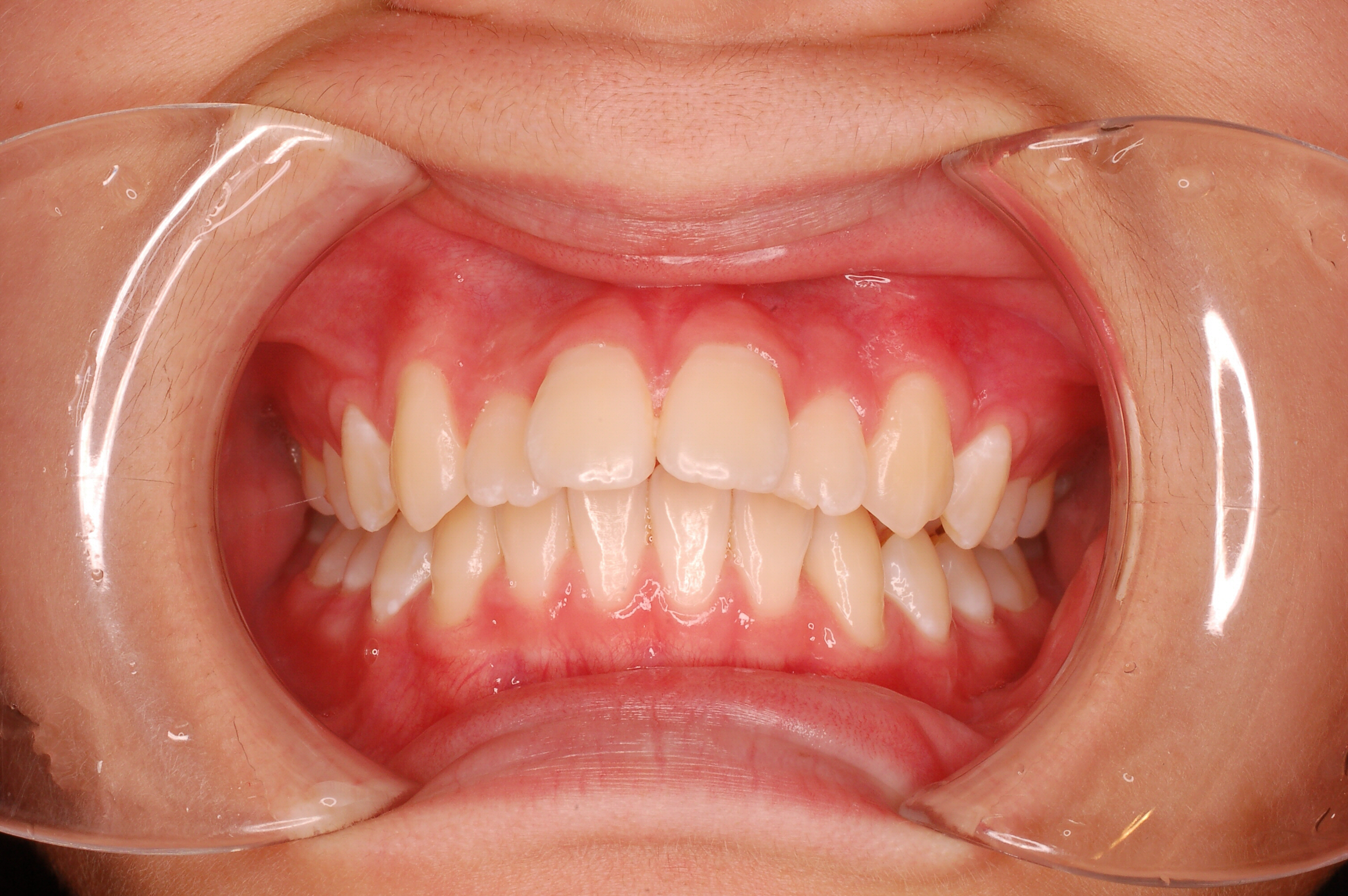 出っ歯症例1_20090902