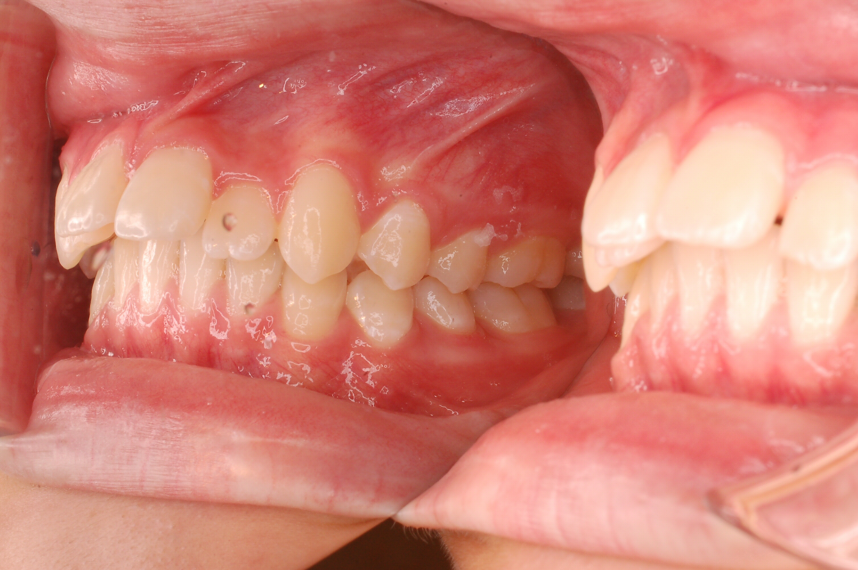出っ歯症例1_20090902