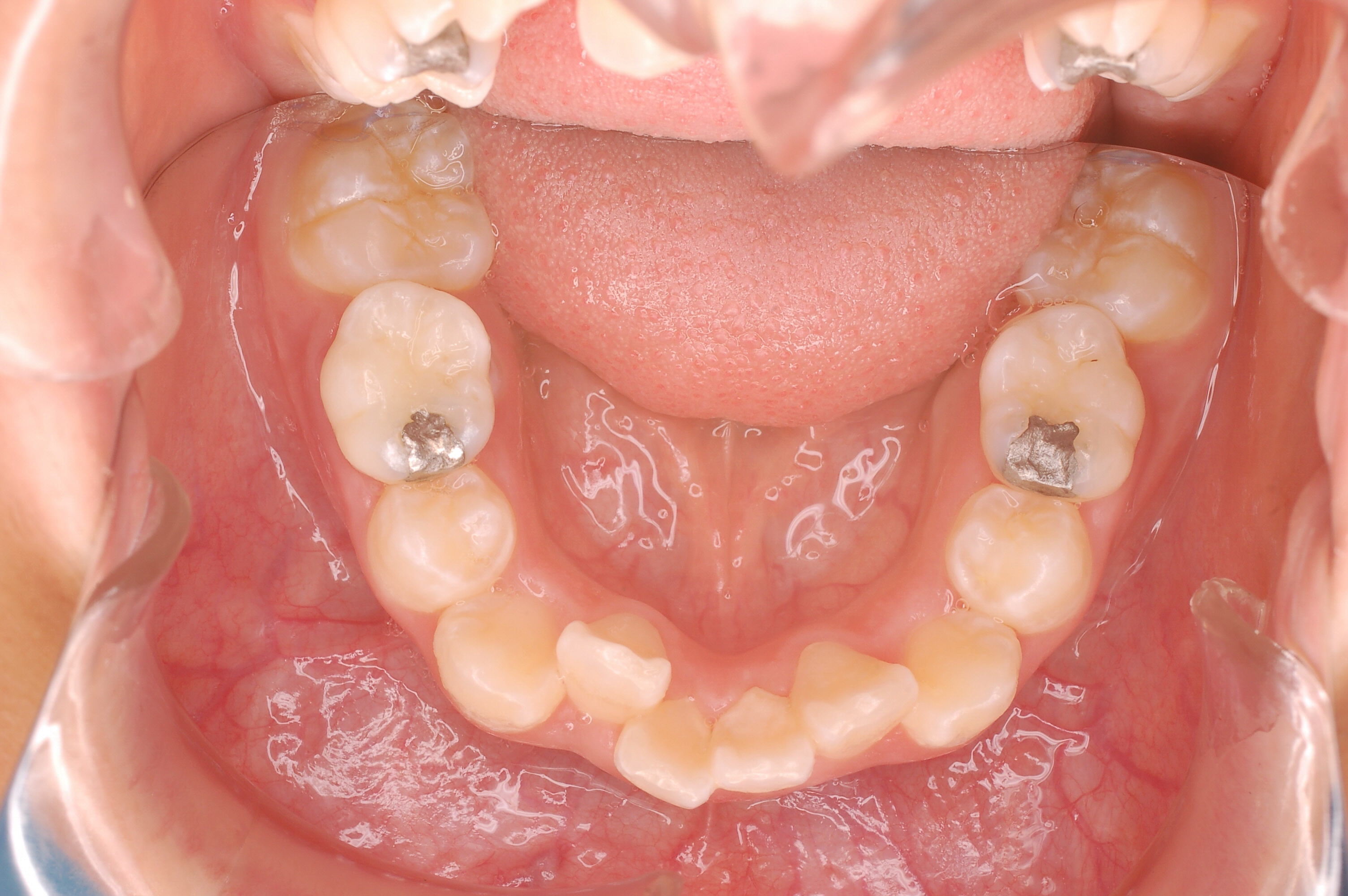 出っ歯症例写真3