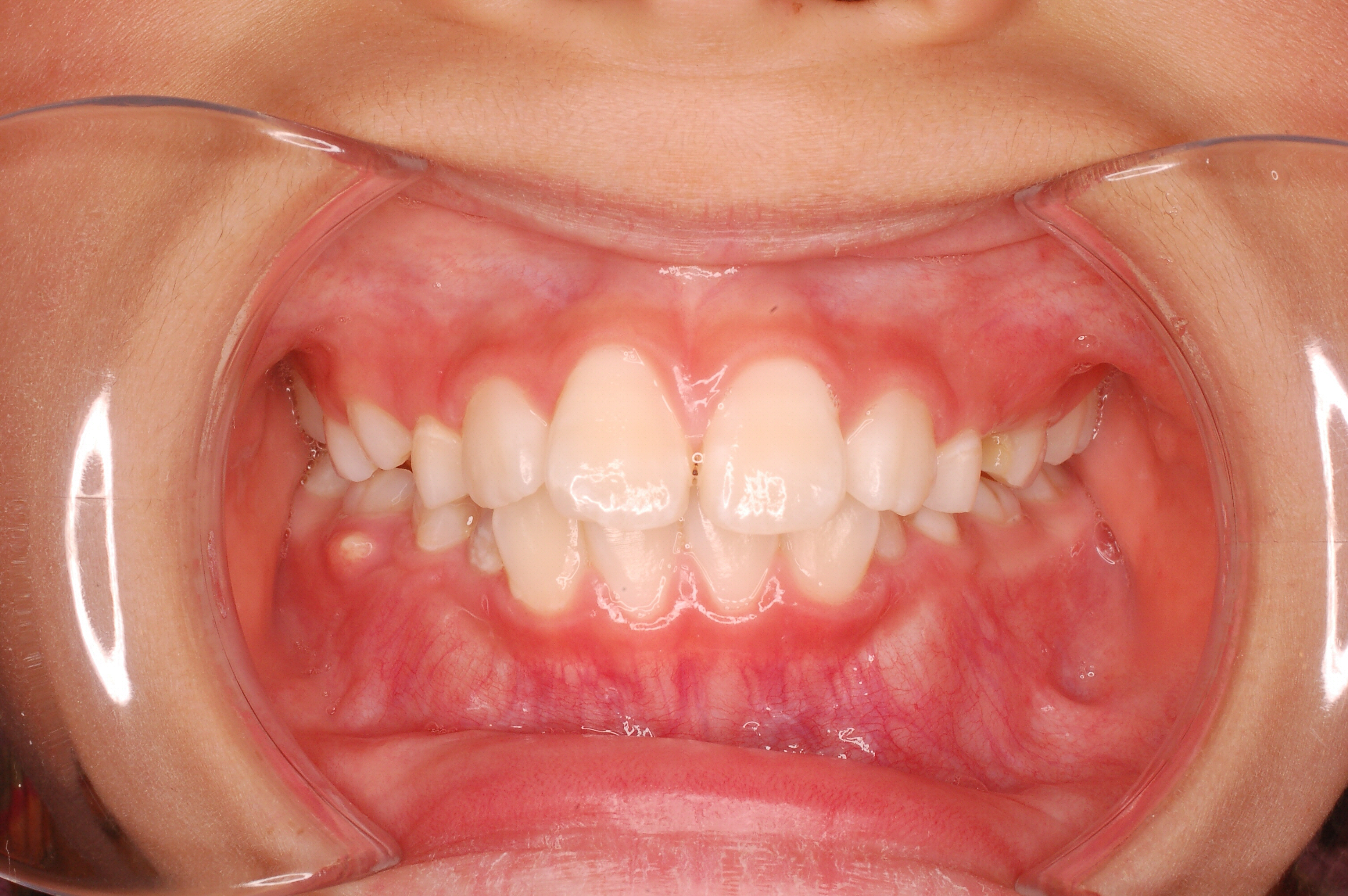 出っ歯症例写真2