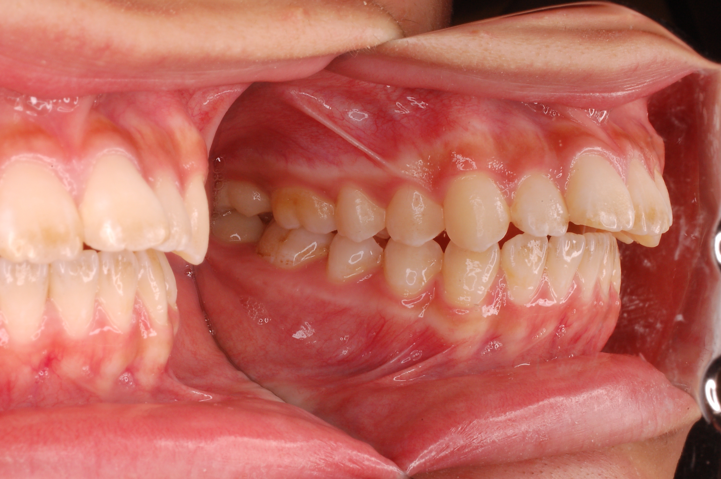 出っ歯症例写真4